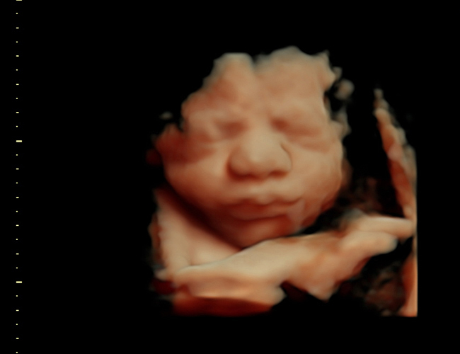 3D ultrasound image at 31 weeks